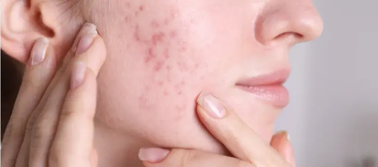 Gentle Acne Treatment and Pore Management Gentle Acne Treatment and Pore Management