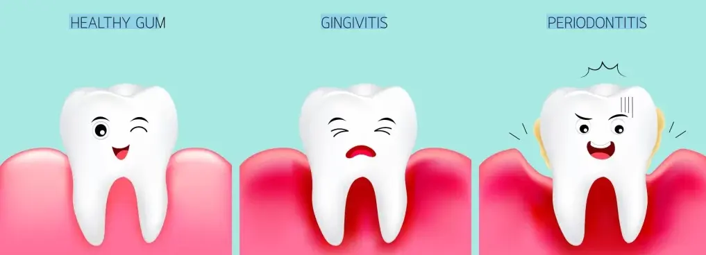  gingivitis