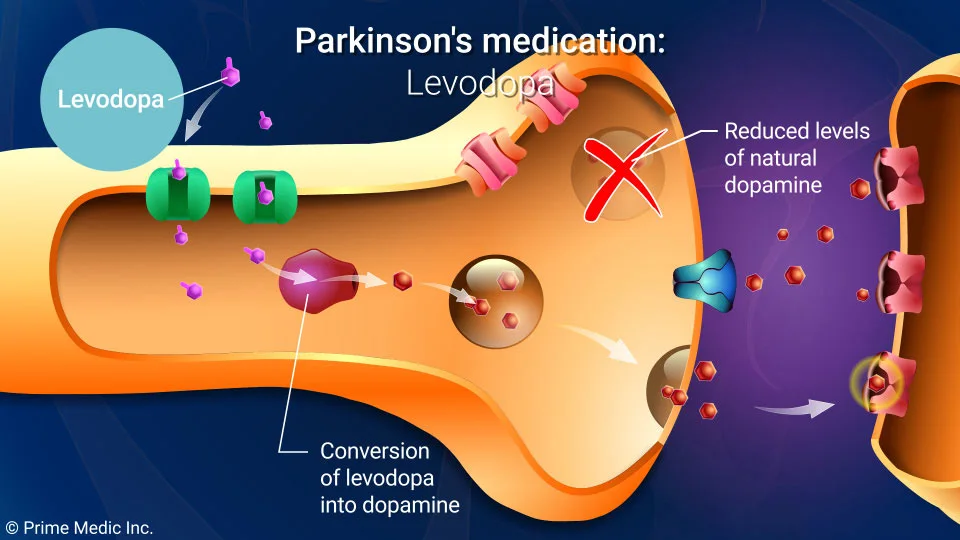 Treatment and Management of Parkinson’s Disease Treatment and Management of Parkinson’s Disease