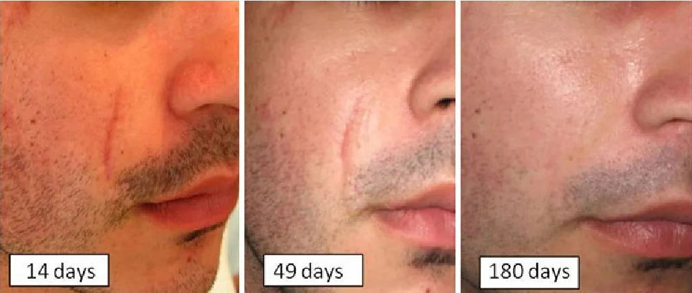 Restorative Effects of Centella Asiatica Leaf Extract in Cosmetics Restorative Effects of Centella Asiatica Leaf Extract in Cosmetics