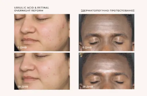 Ursolic Acid for Skin