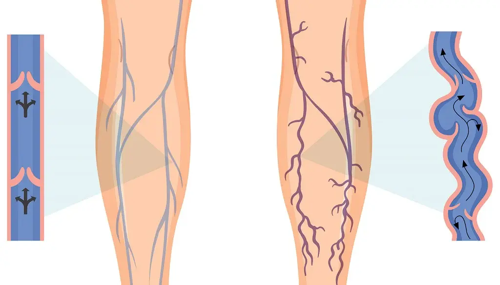 Horse Chestnut Extract Benefits