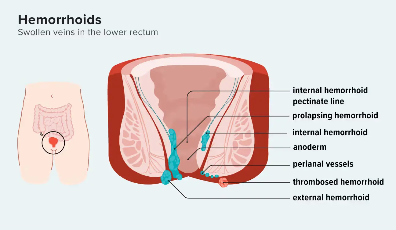 Why Does Horse Chestnut Extract Have Effective Benefits for Hemorrhoids?