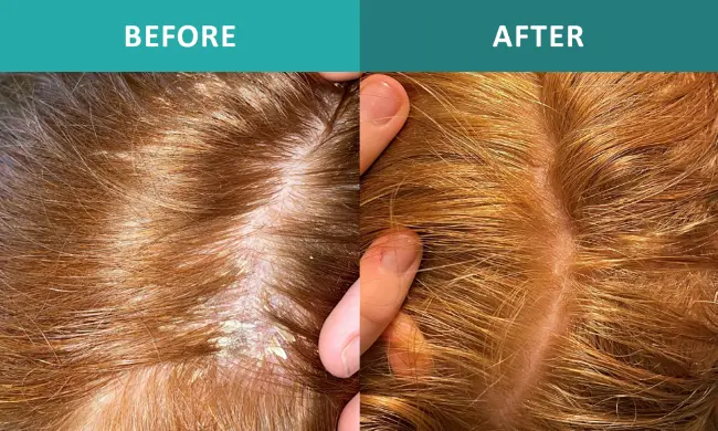 How Does Theaflavin Work for Hair Loss? 