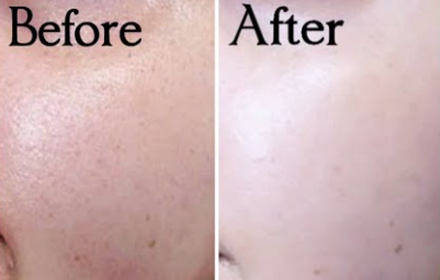 Alpha Arbutin And Niacinamide Before And After Alpha Arbutin And Niacinamide Before And After