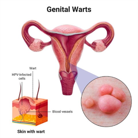 Podophyllin for Warts