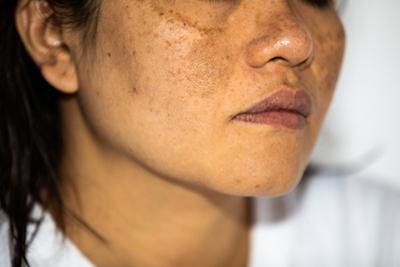 Tranexamic Acid for Discoloration