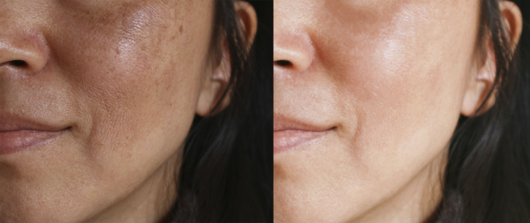 Is Tranexamic Acid Good For Discoloration? Is Tranexamic Acid Good For Discoloration?