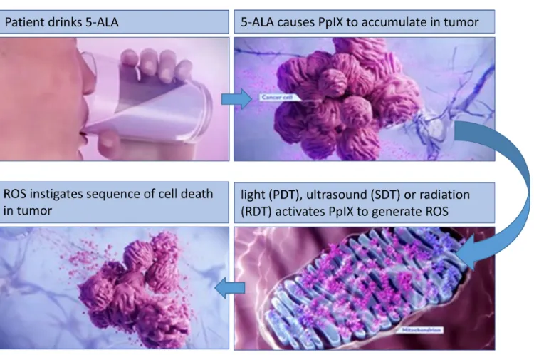 5 ALA For Glioma 5 ALA For Glioma