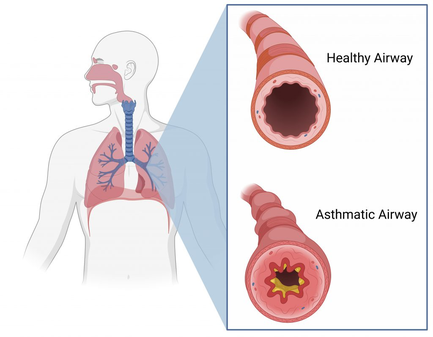 FDP On Asthma FDP On Asthma