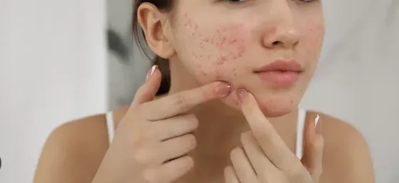 Ascorbyl Glucoside For Acne Ascorbyl Glucoside For Acne