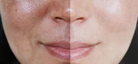 Ascorbyl Glucoside For Hyperpigmentation Ascorbyl Glucoside For Hyperpigmentation