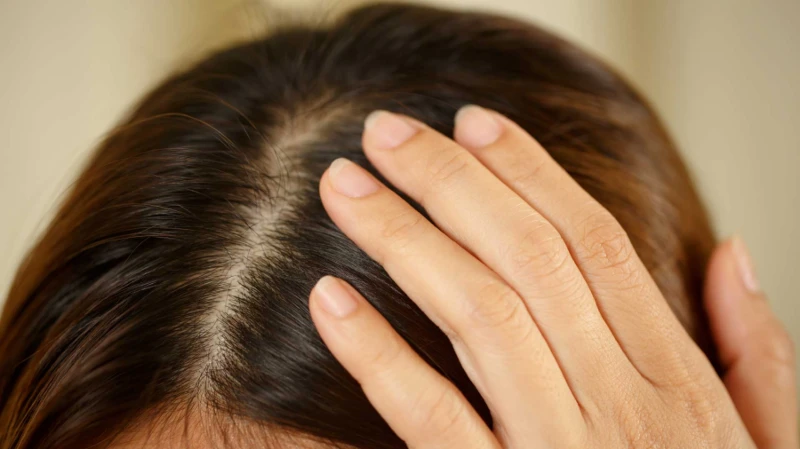 Salicin for Dandruff Salicin for Dandruff