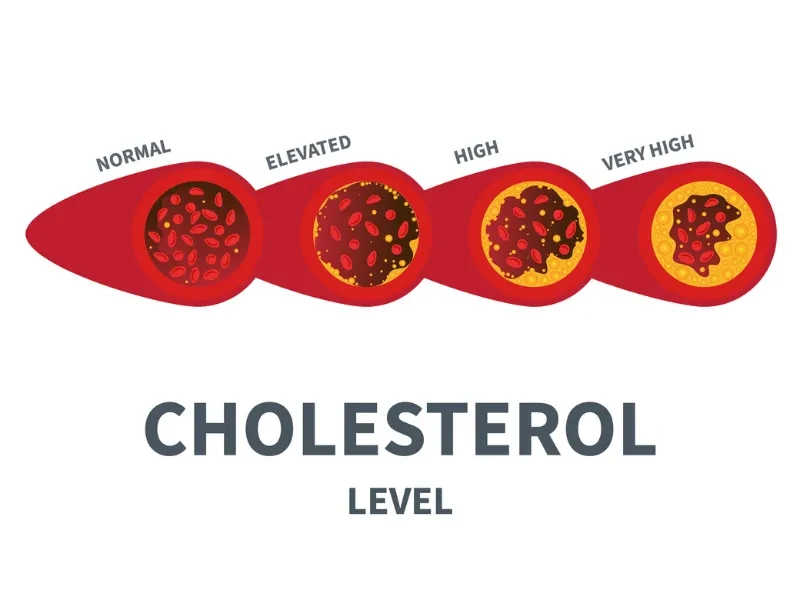 Artichoke Leaf Extract for Cholesterol Artichoke Leaf Extract for Cholesterol